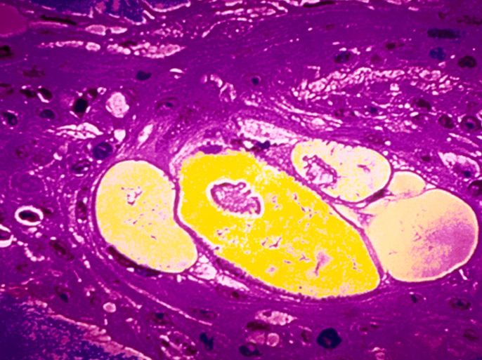 Cervical Cancer Cells, Color Enhacned Micrograph. x400 - صورة لسرطان الرحم - الموسوعة
