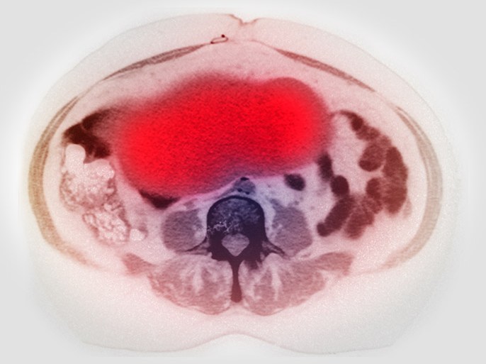 صورة لسرطان المبيض - Ovarian cancer on CT scan - الموسوعة
