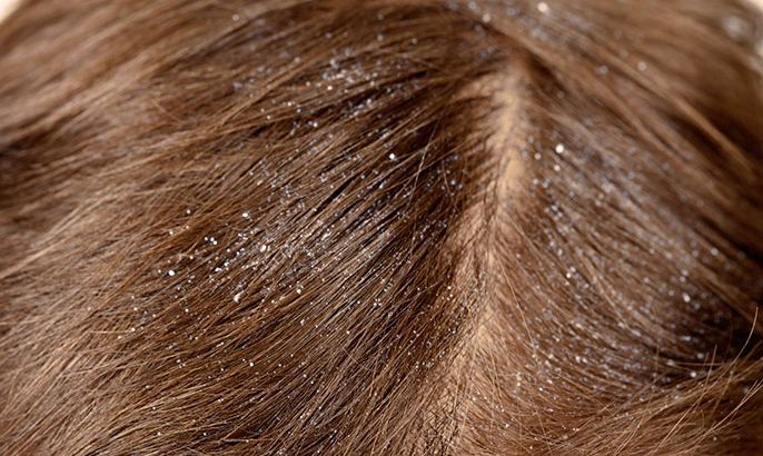Dandruff القشرة - قشرة الرأس - الشعر - الموسوعة