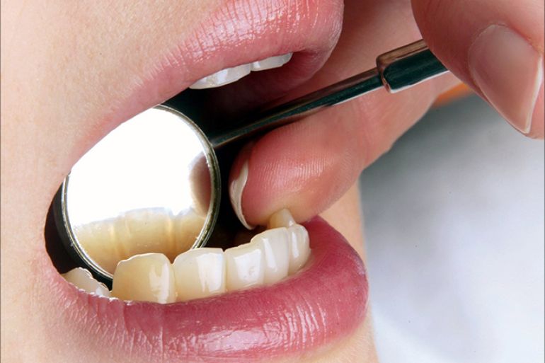 التهاب الأنسجة الداعمة للأسنان يؤدي إلى تآكل اللثة، ومن ثم خلخلة الأسنان. (النشر مجاني لعملاء وكالة الأنباء الألمانية “dpa