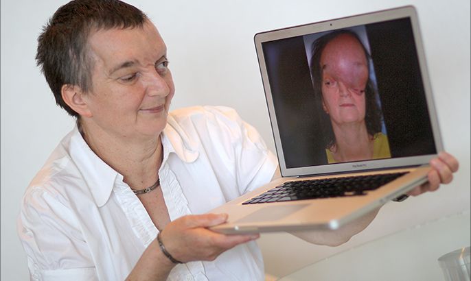 epa04252226 Former tumor patient Elke Barzen on a laptop computer shows a picture of her that was taken prior to a brain and skull tumor surgery followed by a face reconstruction as she attends the 64th annual congress of the German Association for Mouth-, Jaws- and Face Surgery (Deutsche Gesellschaft fuer Mund-, Kiefer- und Gesichtschirurgie, DGMKG) in Mainz, Germany, 12 June 2014. Some 500 experts in this field of reconstructive surgery are expected to attend the congress from 11 to 14 June which is titled 'Taylored Face instead of Face transplantation' and aimed at presenting and discussing new therapies to rebuild humans' faces after severe trauma or tumors. EPA