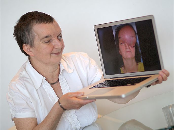 epa04252226 Former tumor patient Elke Barzen on a laptop computer shows a picture of her that was taken prior to a brain and skull tumor surgery followed by a face reconstruction as she attends the 64th annual congress of the German Association for Mouth-, Jaws- and Face Surgery (Deutsche Gesellschaft fuer Mund-, Kiefer- und Gesichtschirurgie, DGMKG) in Mainz, Germany, 12 June 2014. Some 500 experts in this field of reconstructive surgery are expected to attend the congress from 11 to 14 June which is titled 'Taylored Face instead of Face transplantation' and aimed at presenting and discussing new therapies to rebuild humans' faces after severe trauma or tumors. EPA