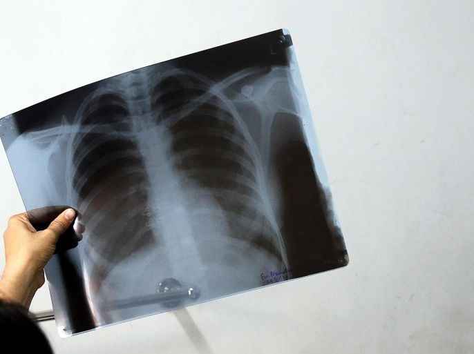 (15/19) A doctor shows a chest x-ray to her patient, Indian beedi worker Manisha, who suffers from severe chest pain at a hospital exclusively for beedi workers in Sagar, Madhya Pradesh, India, 24 November 2014. Beedi rollers donât wear protective clothing as gloves or masks so they are unprotected from the tobacco dust absorbed through their skin and by inhaling the harmful particles which could cause respiratory problems. EPA/HARISH TYAGI PLEASE REFER TO ADVISORY NOTICE (epa04519856) FOR FULL FEATURE TEXT