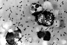 UNDATED PHOTO: A bubonic plague smear, prepared from a lymph removed from an adenopathic lymph node, or bubo, of a plague patient, demonstrates the presence of the Yersinia pestis bacteria that causes the plague in this undated photo. The FBI has confirmed that about 30 vials that may contain bacteria that could cause bubonic or pneumonic plague have gone missing, then found, from the Health Sciences Center at Texas Tech University January 15, 2003 in Lubbock, Texas. The plague, considered a likely bioterror agent since it's easy to make, is easily treatable with antibiotics if diagnosed early and properly.