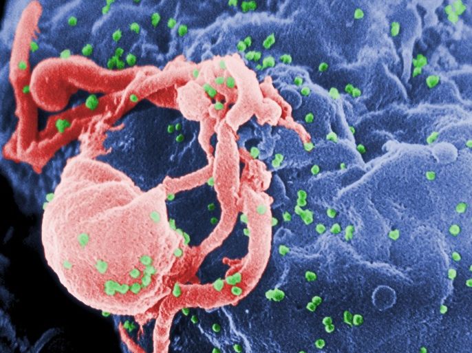 This undated photo provided by the Centers for Disease Control and Prevention shows a scanning electron micrograph of multiple round bumps of the HIV-1 virus on a cell surface. An 18-year-old French woman born with the AIDS virus has had her infection under control and nearly undetectable despite stopping treatment 12 years ago, an unprecedented remission, doctors are reporting, Monday, July 20, 2015. (Cynthia Goldsmith/Centers for Disease Control and Prevention via AP)