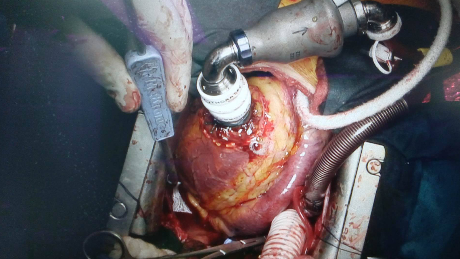 ‪القلب الاصطناعي خلال زراعته للشاب أحمد سياعرة‬ (الصورة من مستشفى النجاح)