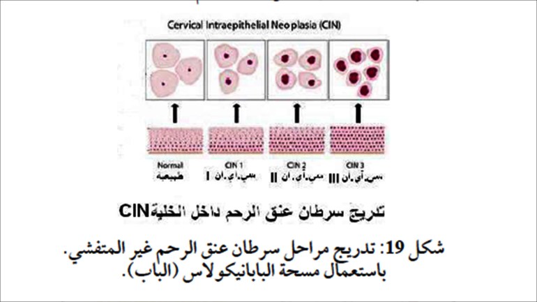 شكل 19: تدريج سرطان عنق الرحم الخلية CIN، من كتاب " حقائق عن السرطان" للدكتورة مي الأرناؤوط، والصادر عن منظمة المجتمع العلمي العربي بالتعاون مع دار الربان للنشر.