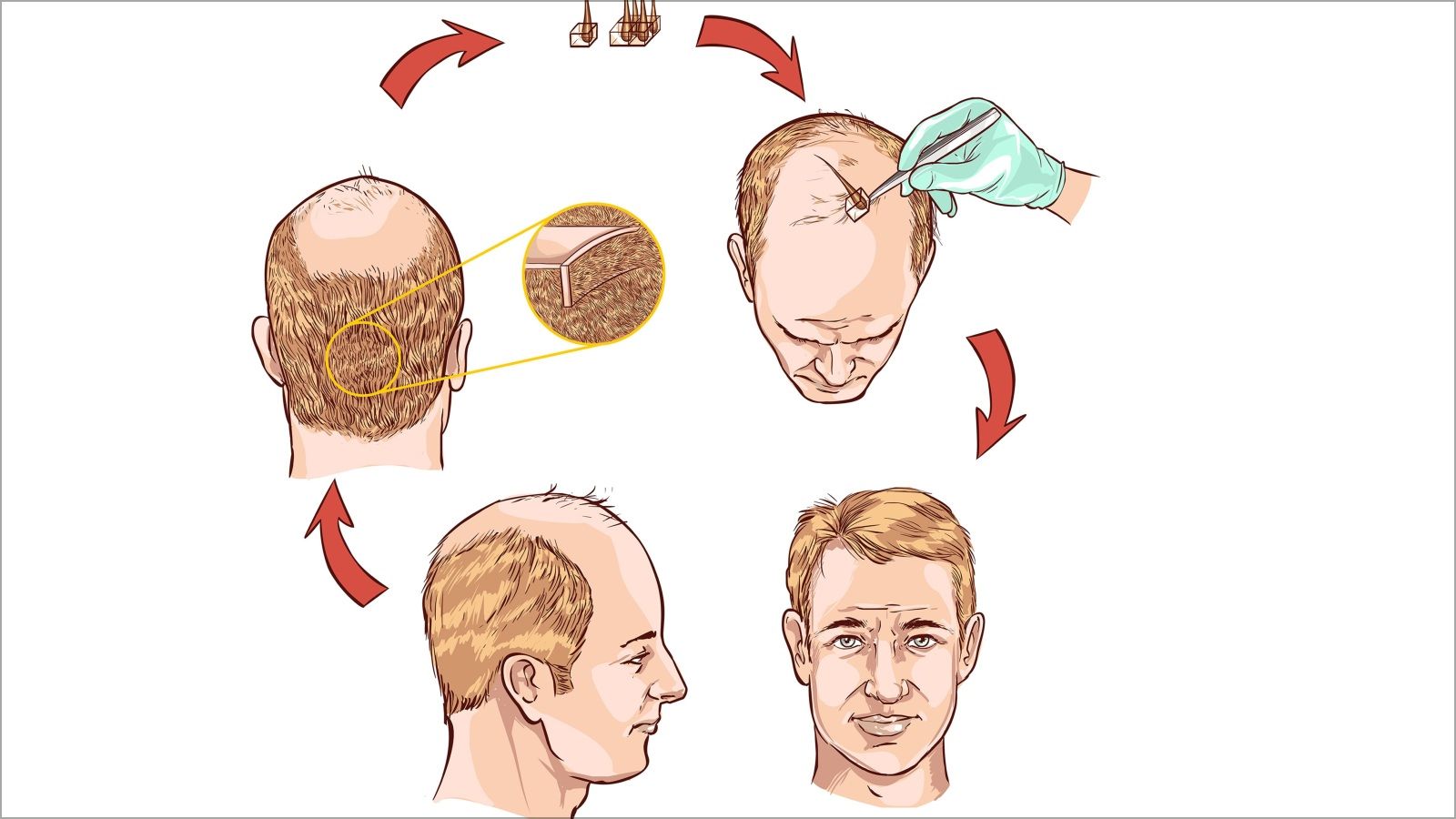 طريقة (strip harvesting)  في زراعة الشعر (سيردار كورباسي/دريمزتايم)