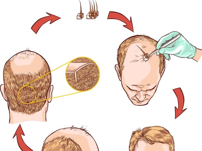 زراعة الشعر، الوكالة الفرعية: سيردار كورباسي، الوكالة الرئيسية دريمزتايم, Hair transplantation