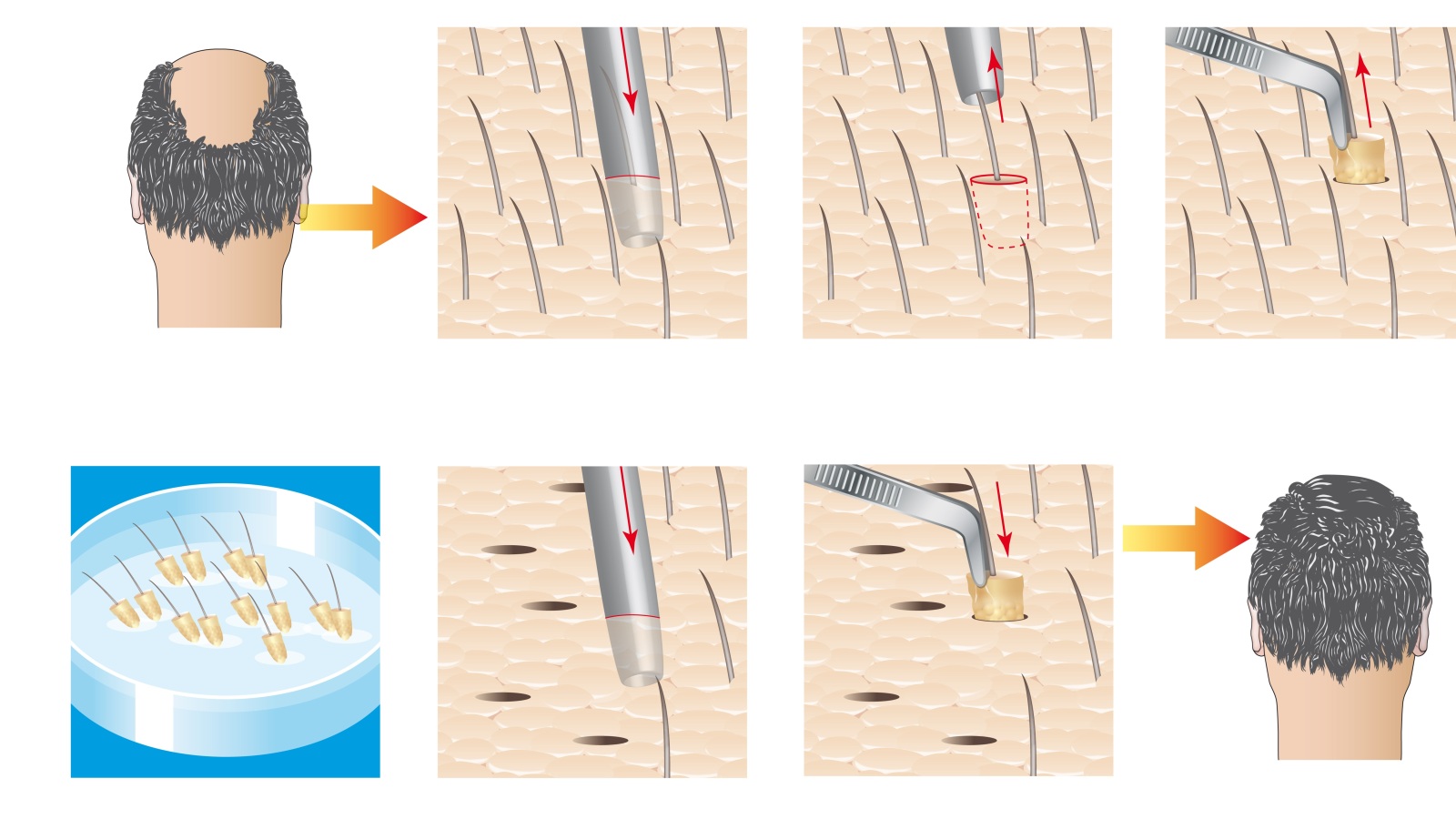 طريقة (follicular unit extraction) في زراعة الشعر (أليكس أونلاين/ دريمزتايم)