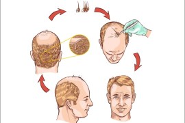 زراعة الشعر، الوكالة الفرعية: سيردار كورباسي، الوكالة الرئيسية دريمزتايم Hair transplantation