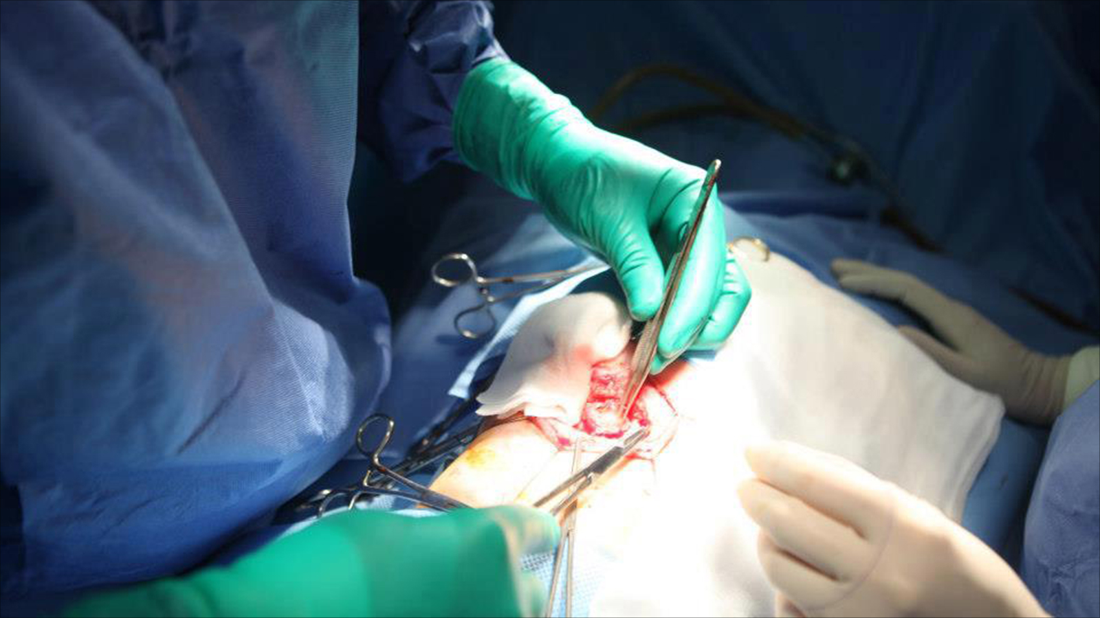 ‪التدخل الجراحي حسب مختصين في جراحة الأعصاب لا يضمن عودة الوظيفة الطبيعية للجزء المتضرر من الحبل الشوكي‬ (الجزيرة)