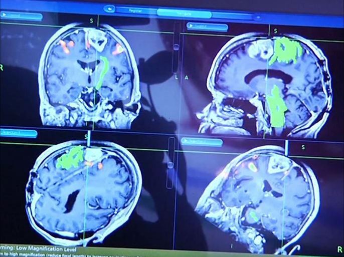 كشف علمي جديد يمهد لعلاج سرطان الدماغ