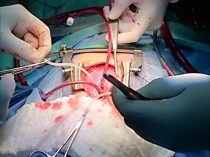 عملية جراحية قسم جراحة قلب الأطفال - مستشفى المقاصد -القدس