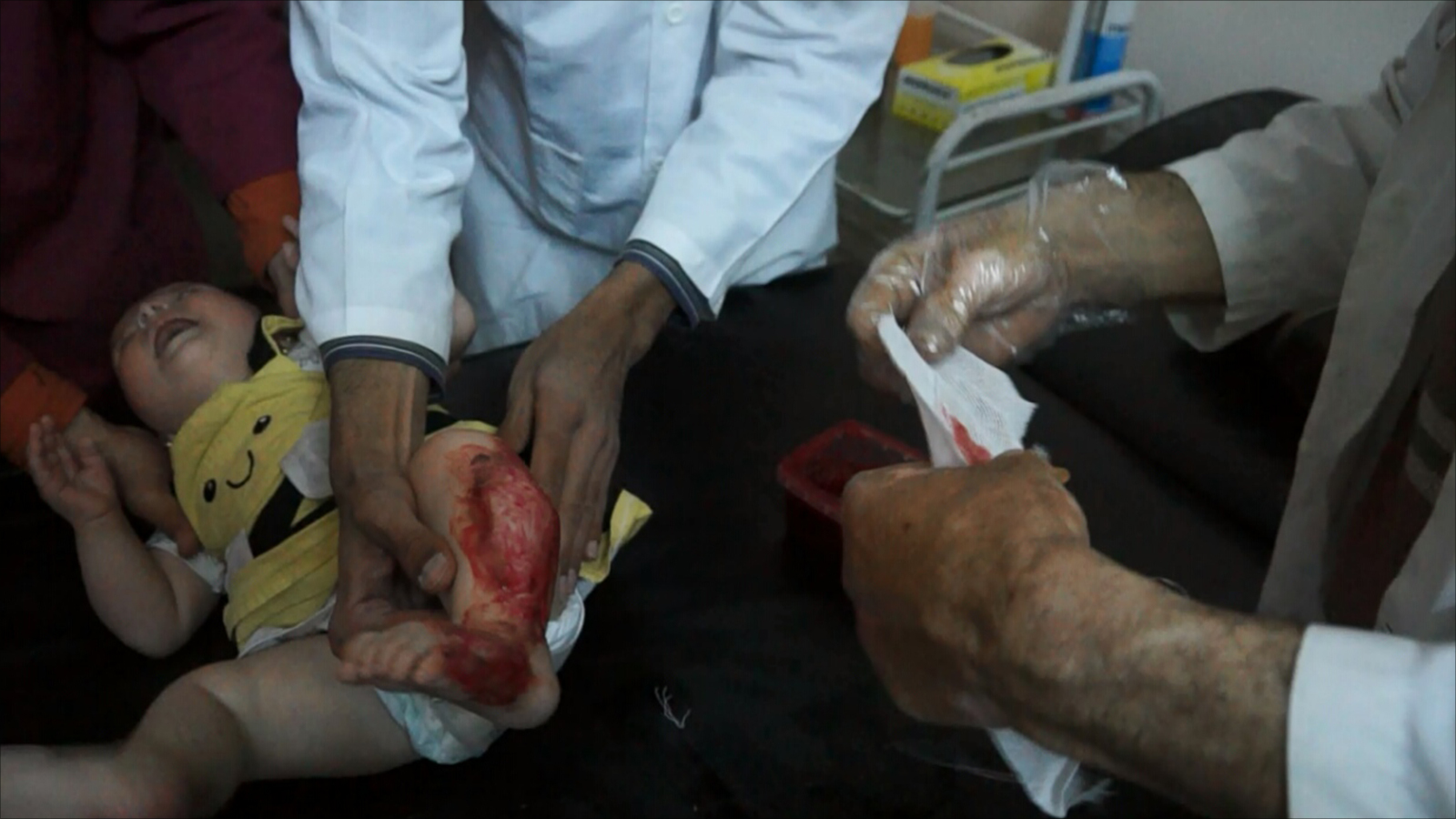 طفل مصاب جراء قصف النظام على حي الوعر يتلقى العلاج بمشفى الوليد (الجزيرة)