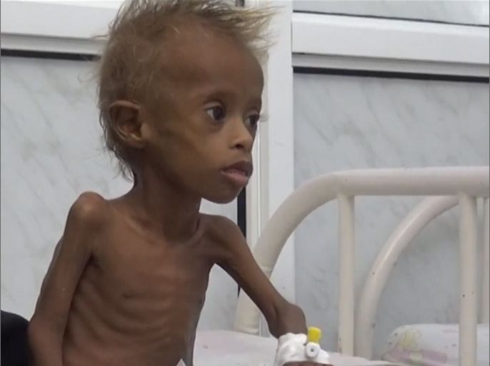 انتشار سوء التغذية بقرى المتينة غربي اليمن