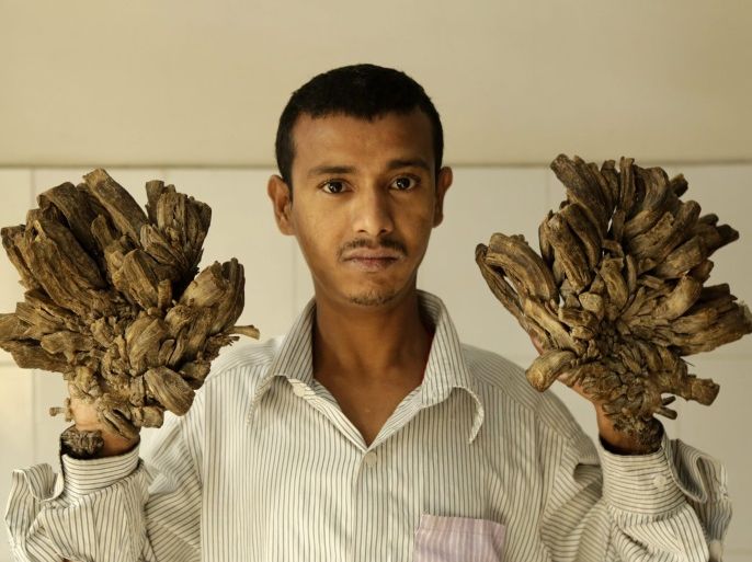 Abul Bajandar, a patient diagnosed with epidermodysplasia verruciformis, a rare skin disease, awaits treatment at the Dhaka Medical College, in Dhaka, Bangladesh, 02 February 2016. Bajandar has been suffering bark-like warts on his hands and feet since four years. The man together with his wife and one daughter live in the southern district of Khuna.