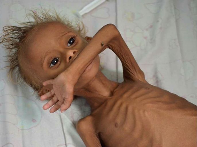 المجاعة تهدد أطفال اليمن - (الصور من منظمات انسانسة)