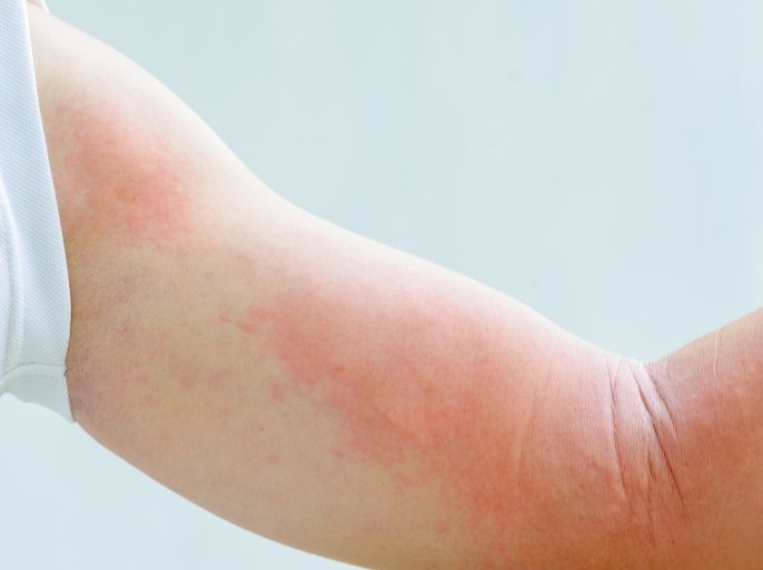 قد تتضمن أعراض ردة الفعل التحسسية للسعات الحشرات الطفح الجلدي والتورم.المصدر: : مؤسسة حمد الطبية