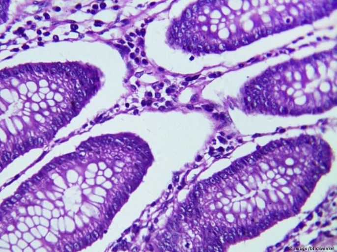 خلايا سرطانية في نسيج حي كما يظهرها مجهر مكبّرة 400 مرة.