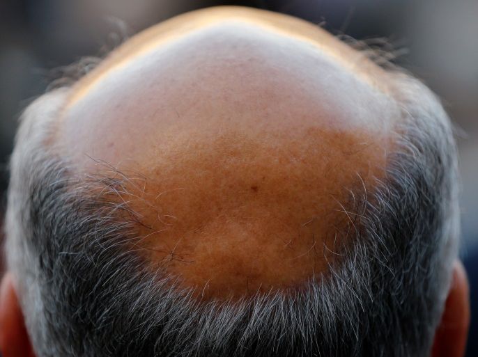 A man with baldness is seen in Seville, southern Spain April 6, 2016. REUTERS/Marcelo del Pozo
