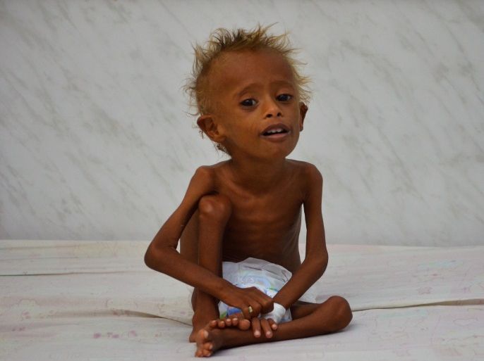 Salem Abdullah Musabih, 6, sits on a bed at a malnutrition intensive care unit at a hospital in the Red Sea port city of Hodaida, Yemen September 11, 2016. REUTERS/Abduljabbar Zeyad SEARCH