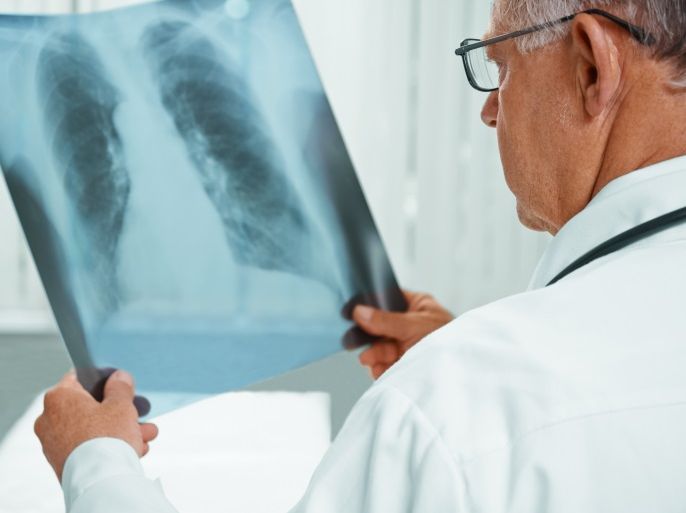 صور الأشعة لمنطقة الصدر هي أفضل الفحوصات التشخيصية للكشف عن الإصابة بالالتهاب الرئوي الحادّ.
