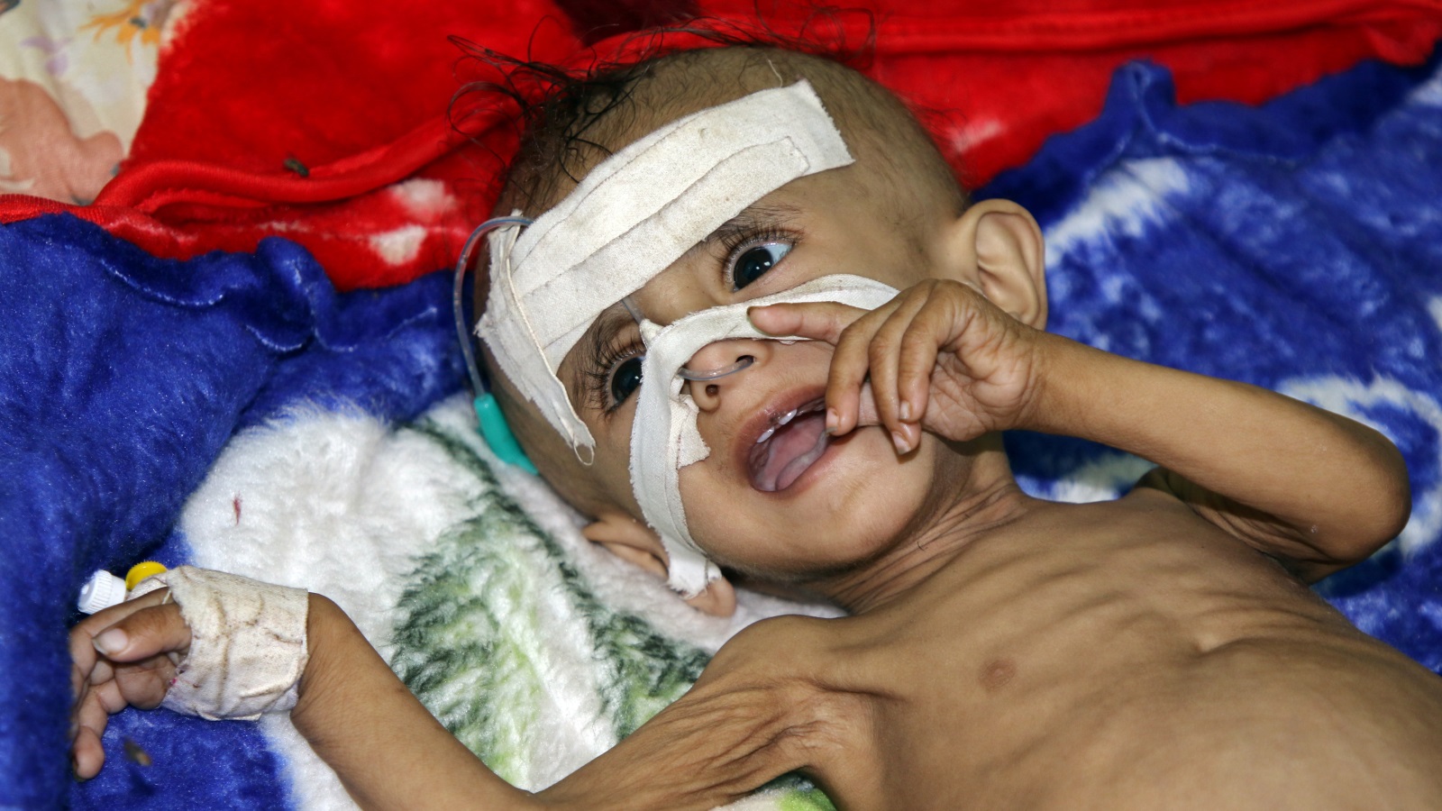 ‪طفلة عمرها عام واحد في مستشفى الحوطة بمحافظة لحج جنوبي اليمن حيث تعاني من سوء تغذية حاد (رويترز)‬ طفلة عمرها عام واحد في مستشفى الحوطة بمحافظة لحج جنوبي اليمن حيث تعاني من سوء تغذية حاد (رويترز)