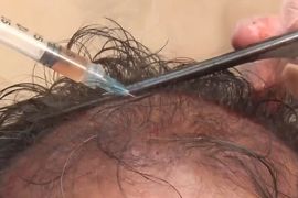 هذا الصباح-تقنية جديدة لزراعة الشعر