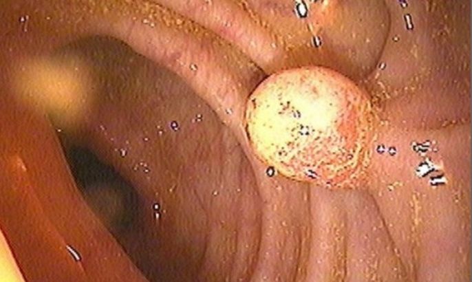 A photo taken during a traditional colonoscopy is seen in this handout photo released by the University of Wisconsin Medical School. A study in Thursday's New England of Journal shows that "virtual colonoscopy" works as well as the more invasive conventional colonoscopy to detect suspicious polyps.