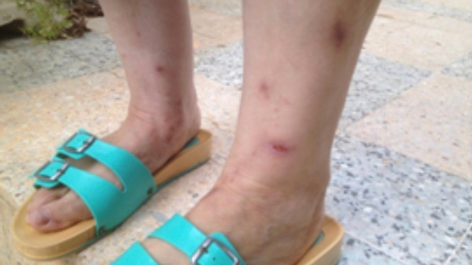 شخص مصاب بلسعات بعوض النمر في الجزائر (معهد باستور)