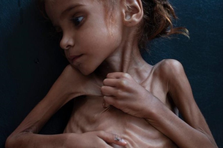 الطفلة اليمنية أمل هزت ضمائر العالم ولفتت الانتباه إلى الحرب المستعرة في اليمن