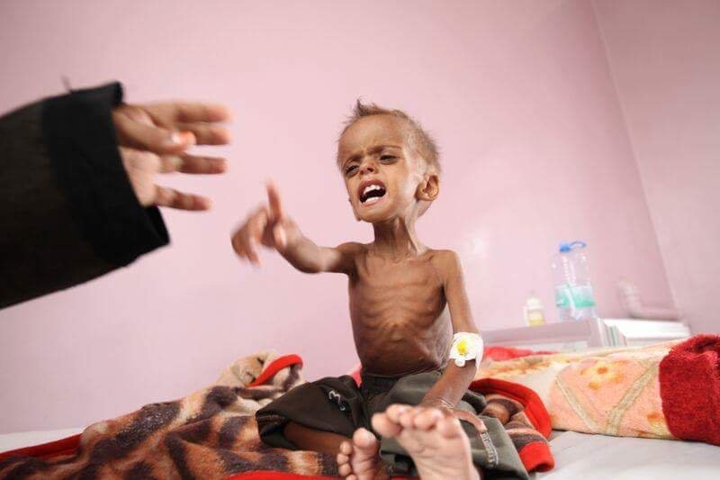أوضاع مرعبة لأطفال اليمن (مواقع التواصل )