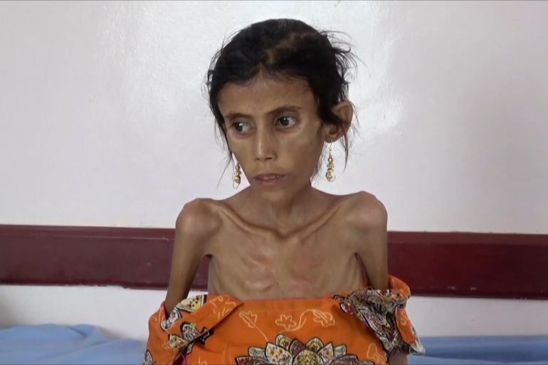 الجوع وسوء التغذية يفتكان بأطفال اليمن
