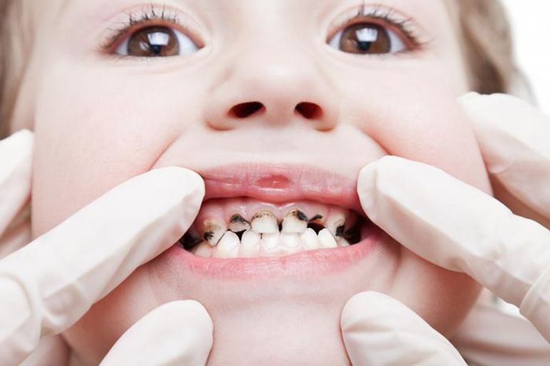 صورة من دوتشيه فيلله.. هكذا تحمي طفلك من مرض "الأسنان الطباشيرية"