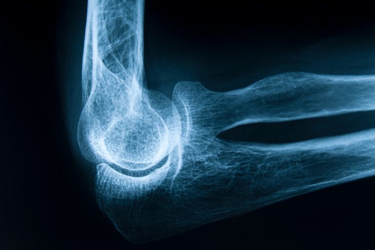 X-Ray image of the Human elbow bone. Front view.