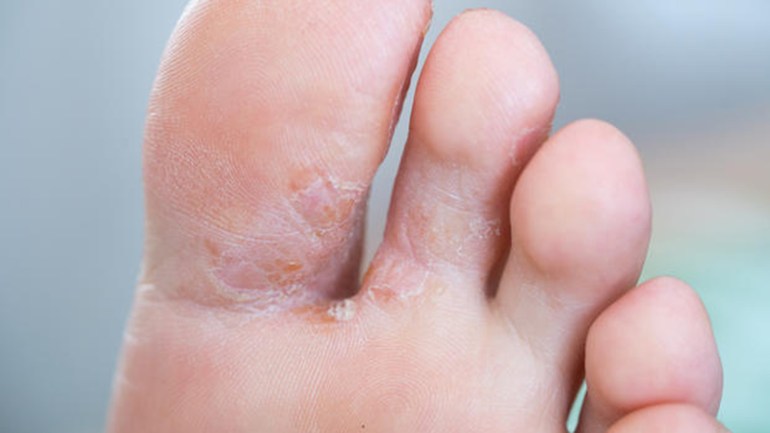 فطريات القدم تصيب أصابع القدم بصفة خاصة، وهي تستقر في الشقوق، التي تنشأ بسبب جفاف جلد القدم. صور: dpa Credit: dpa