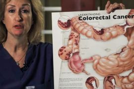 What is Colorectal Cancer? - Mayo Clinic