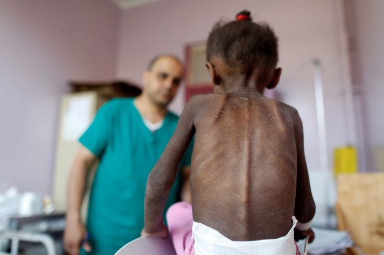 A nurse looks as he weighs a malnourished girl at a malnutrition treatment center in Sanaa, Yemen October 7, 2018. Picture taken October 7, 2018. REUTERS/Khaled Abdullah