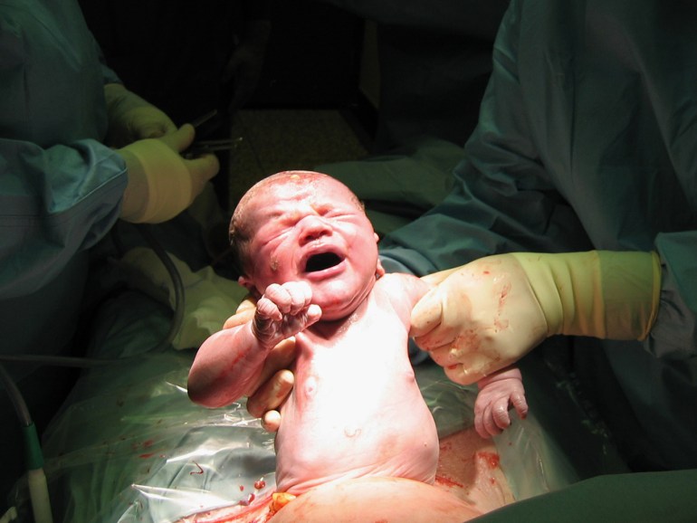مقترح الولادة القيصرية وانتشارها في مصر