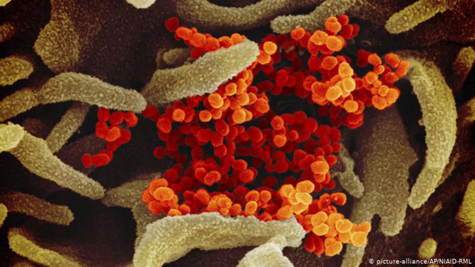 ‪صورة مقطعية لفيروس كورونا (الجزيئات البرتقالية) أثناء مهاجمته الأهداب‬ (دويتشه فيله)