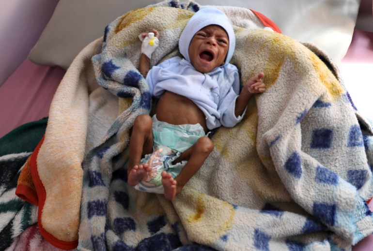 Child malnutrition at record highs in parts of Yemen -U.N. survey