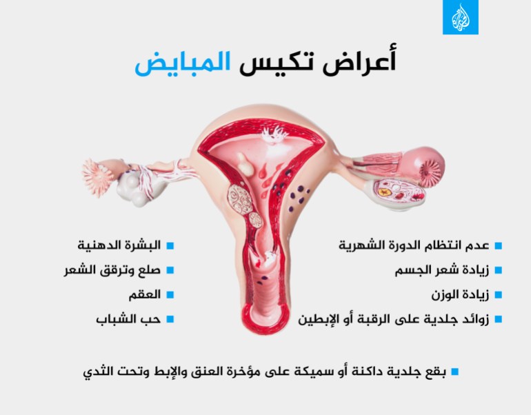 أعراض تكيس المبايض مبيض عقم صحة المرأة إنفوغراف
