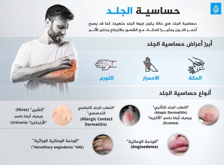التهاب الجلد إنفوغراف حساسية الجلد إكزيما أكزيما جلدية صحة الجلد