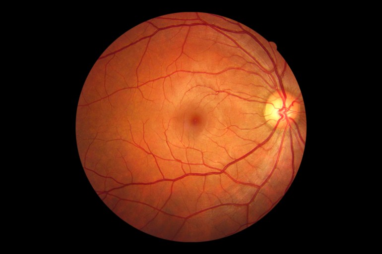 Human eye anatomy taking images with Mydriatic Retinal cameras
