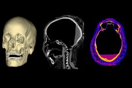 تشير التشوهات في جمجمة المومياء الحامل إلى وجود ورم كبير خلف العين اليسرى (مشروع مومياء وارسو)