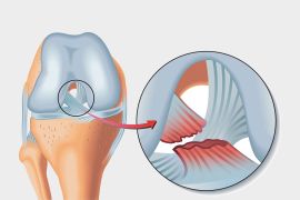 Medical Illustration of anterior cruciate ligament rupture. shutterstock_1981046210