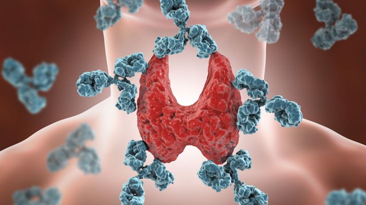 الدرقية درقية Autoimmune thyroiditis, Hashimoto's disease. 3D illustration showing antibodies attacking thyroid gland; Shutterstock ID 708162991; purchase_order: AJA; job: ; client: ; other: الدرقية درقية