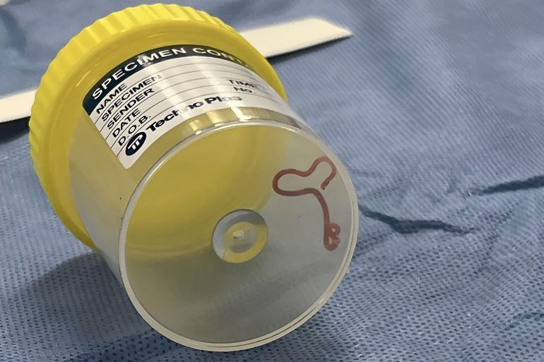 This undated photo supplied by Canberra Health Services, shows a parasite in a specimen jar at a Canberra hospital in Australia. A neurosurgeon investigating a patient's mystery neurological symptoms in an Australian hospital has been surprised to pluck a 3-inch wriggling worm from her brain. (Canberra Health Services via AP)