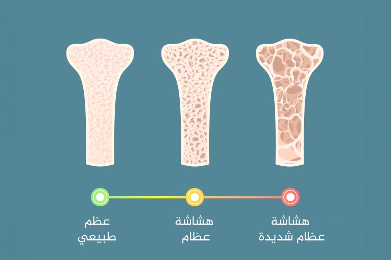 Osteoporosis progress, illustration. تطور هشاشة العظام